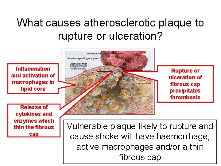 What causes atherosclerotic plaque to rupture or ulceration? Inflammation and activation of macrophages in