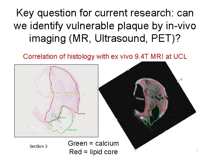 Key question for current research: can we identify vulnerable plaque by in-vivo imaging (MR,