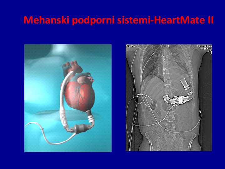 Mehanski podporni sistemi-Heart. Mate II 