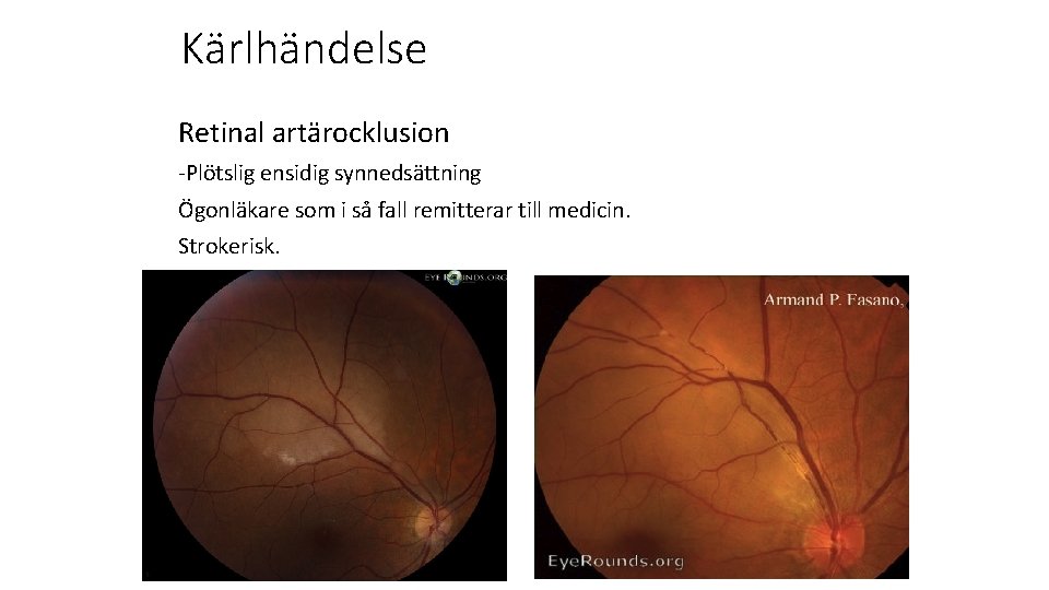 Kärlhändelse Retinal artärocklusion -Plötslig ensidig synnedsättning Ögonläkare som i så fall remitterar till medicin.