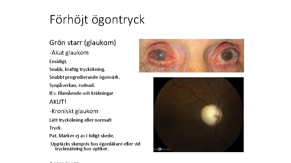Förhöjt ögontryck Grön starr (glaukom) -Akut glaukom Ensidigt. Snabb, kraftig tryckökning. Snabbt progredierande ögonvärk.