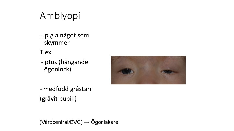 Amblyopi. . . p. g. a något som skymmer T. ex - ptos (hängande