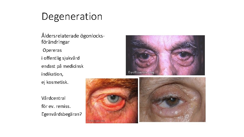 Degeneration Åldersrelaterade ögonlocksförändringar Opereras i offentlig sjukvård endast på medicinsk indikation, ej kosmetisk. Vårdcentral
