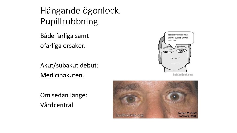 Hängande ögonlock. Pupillrubbning. Både farliga samt ofarliga orsaker. Akut/subakut debut: Medicinakuten. Om sedan länge: