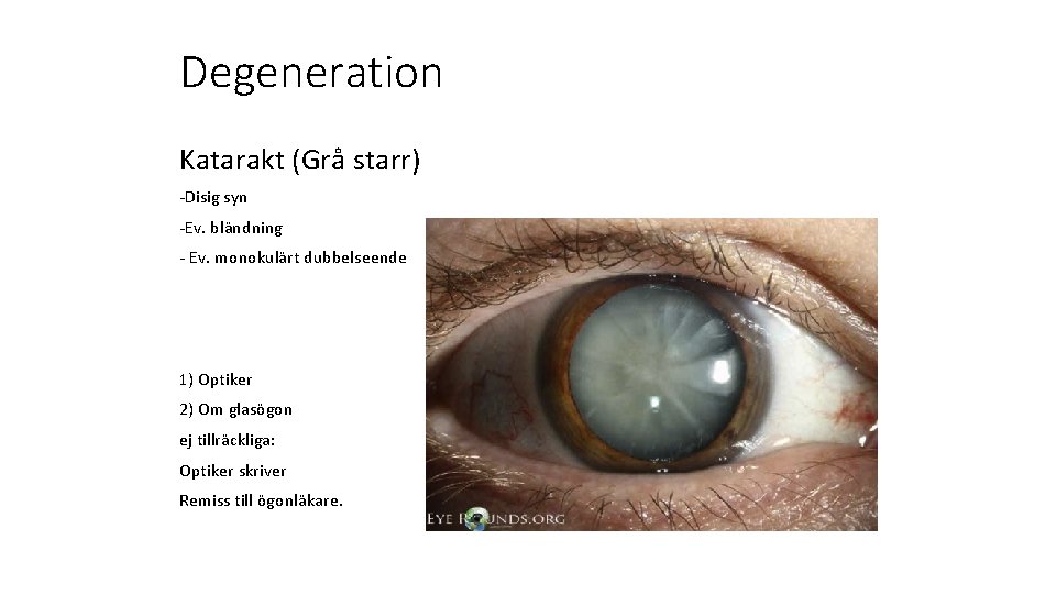 Degeneration Katarakt (Grå starr) -Disig syn -Ev. bländning - Ev. monokulärt dubbelseende 1) Optiker