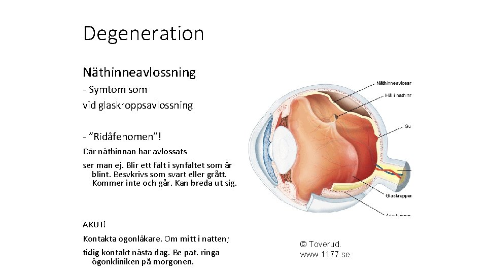 Degeneration Näthinneavlossning - Symtom som vid glaskroppsavlossning - ”Ridåfenomen”! Där näthinnan har avlossats ser