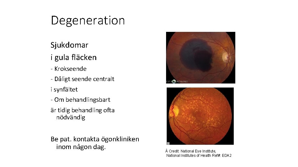 Degeneration Sjukdomar i gula fläcken - Krokseende - Dåligt seende centralt i synfältet -