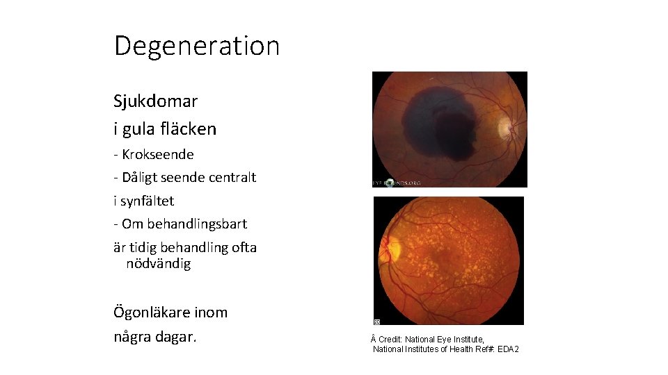 Degeneration Sjukdomar i gula fläcken - Krokseende - Dåligt seende centralt i synfältet -