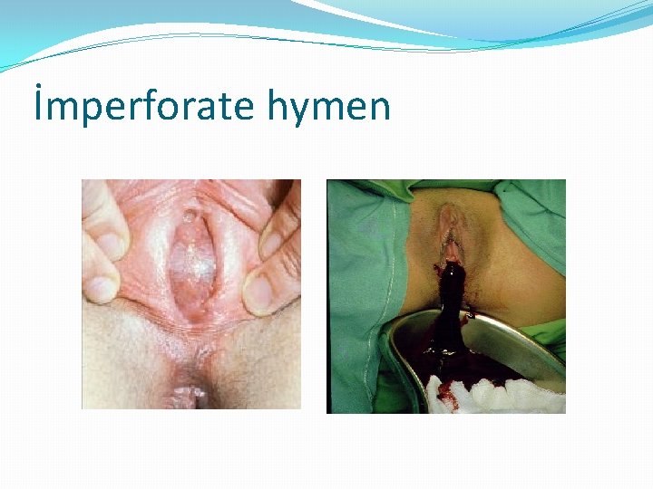 İmperforate hymen 