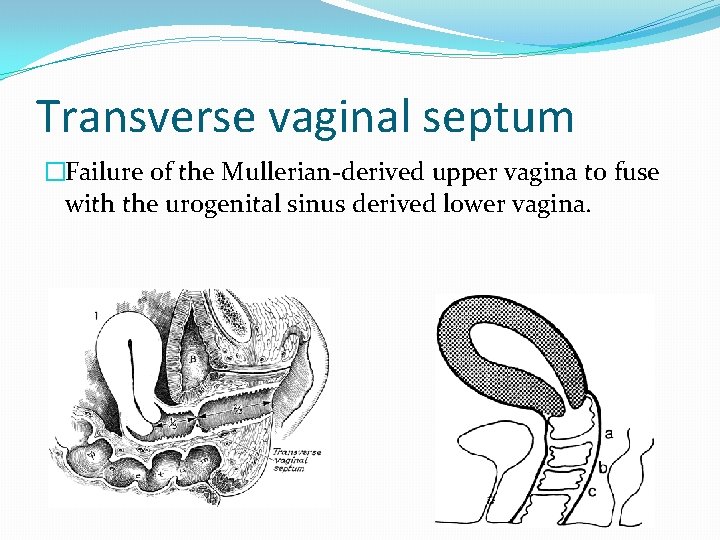 Transverse vaginal septum �Failure of the Mullerian-derived upper vagina to fuse with the urogenital