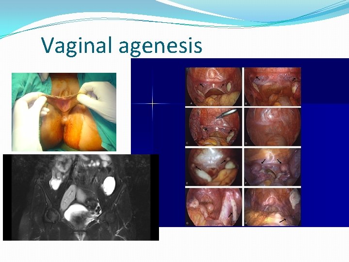 Vaginal agenesis 