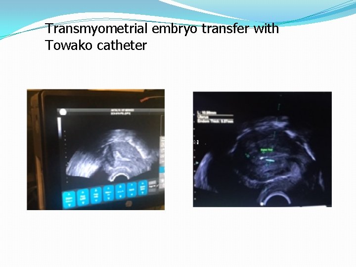 Transmyometrial embryo transfer with Towako catheter 