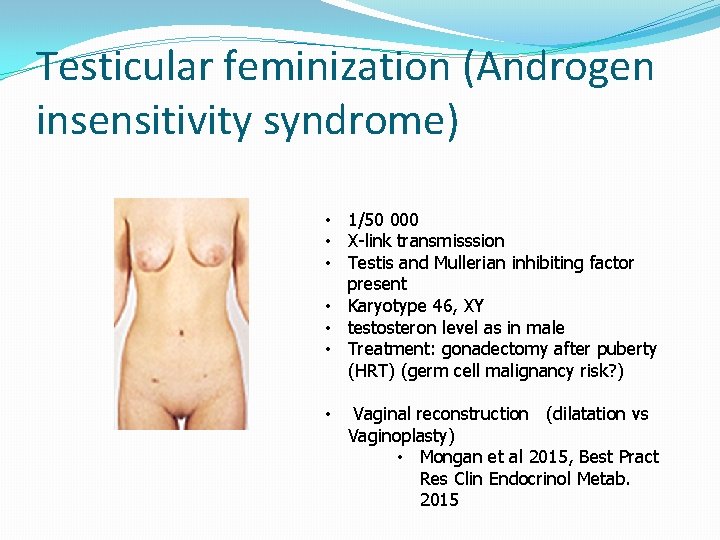 Testicular feminization (Androgen insensitivity syndrome) • 1/50 000 • X-link transmisssion • Testis and