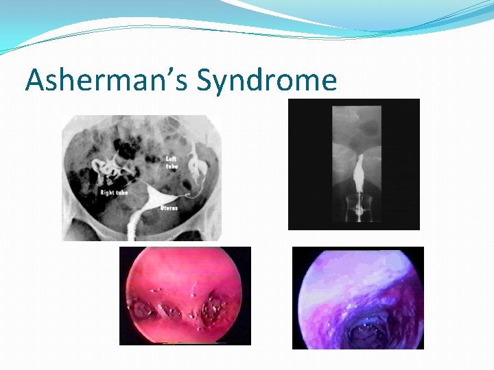 Asherman’s Syndrome 