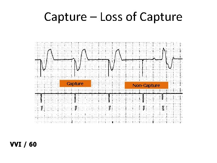 Capture – Loss of Capture VVI / 60 Non-Capture 