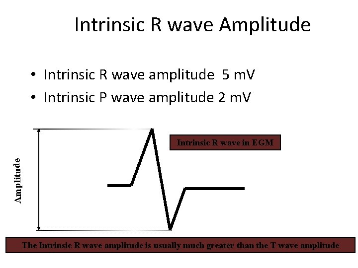 Intrinsic R wave Amplitude • Intrinsic R wave amplitude 5 m. V • Intrinsic