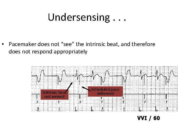 Undersensing. . . • Pacemaker does not “see” the intrinsic beat, and therefore does