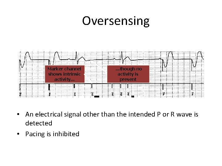 Oversensing Marker channel shows intrinsic activity. . . though no activity is present •