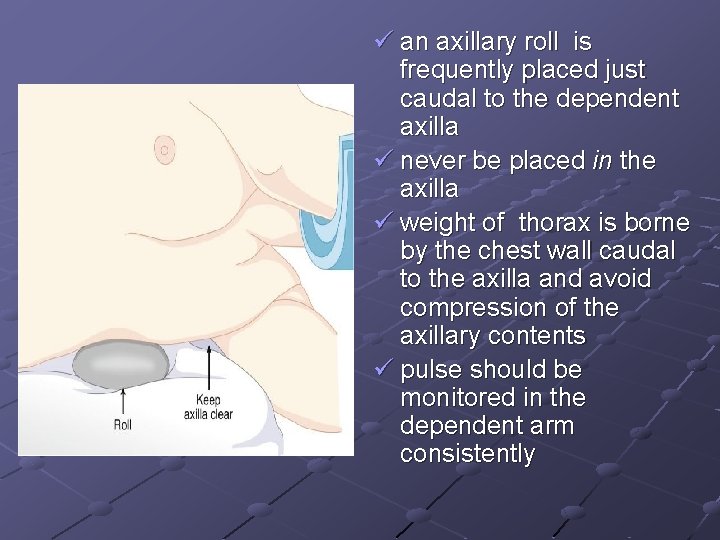 ü an axillary roll is frequently placed just caudal to the dependent axilla ü