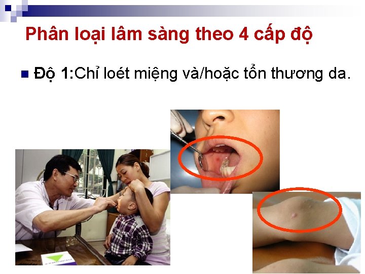 Phân loại lâm sàng theo 4 cấp độ n Độ 1: Chỉ loét miệng