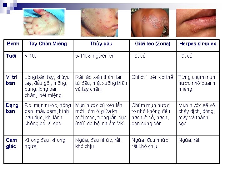 Bệnh Tay Chân Miệng Thủy đậu 5 -11 t & người lớn Giời leo