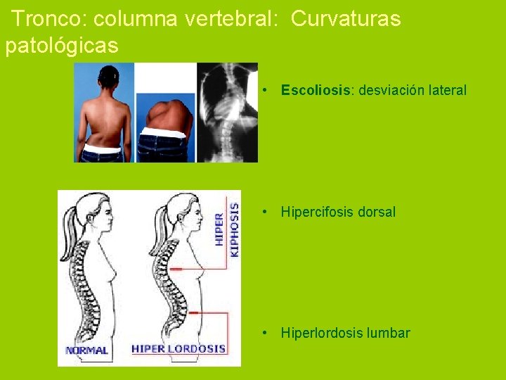  Tronco: columna vertebral: Curvaturas patológicas • Escoliosis: desviación lateral • Hipercifosis dorsal •