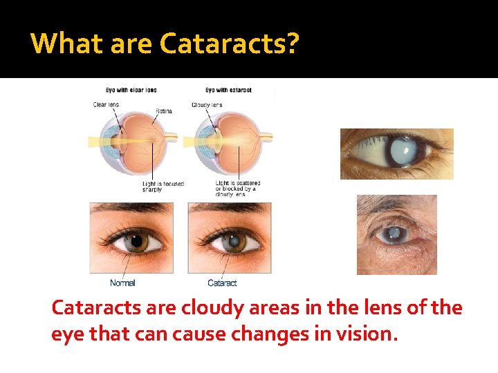 What are Cataracts? Cataracts are cloudy areas in the lens of the eye that