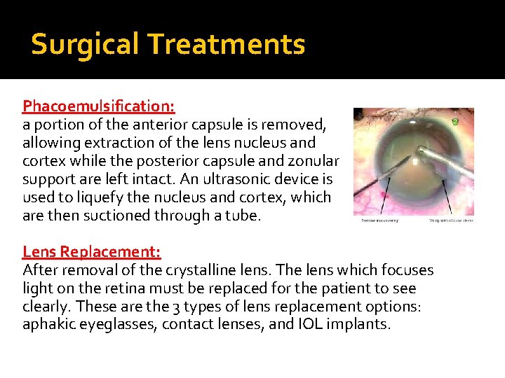 Surgical Treatments Phacoemulsification: a portion of the anterior capsule is removed, allowing extraction of