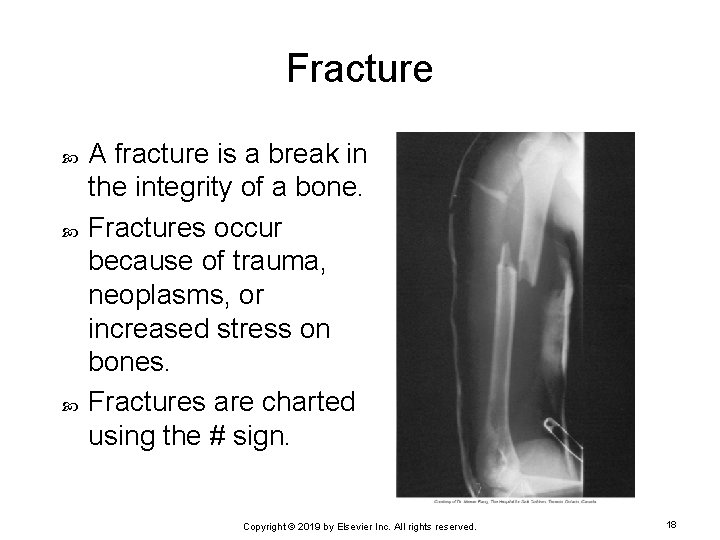 Fracture A fracture is a break in the integrity of a bone. Fractures occur