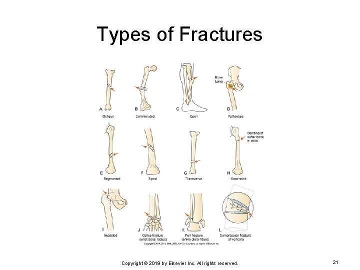 Types of Fractures Copyright © 2019 by Elsevier Inc. All rights reserved. 21 
