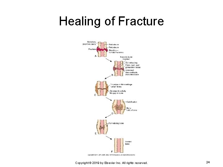 Healing of Fracture Copyright © 2019 by Elsevier Inc. All rights reserved. 24 