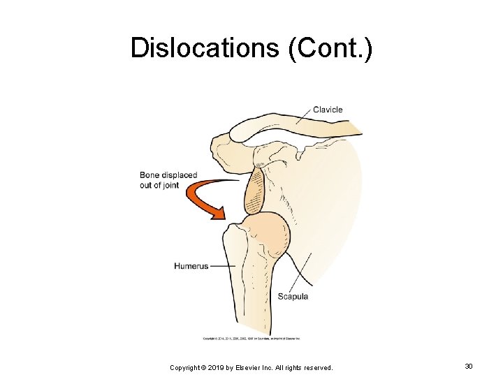 Dislocations (Cont. ) Copyright © 2019 by Elsevier Inc. All rights reserved. 30 