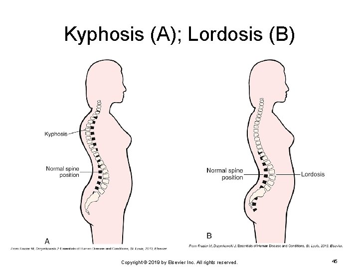 Kyphosis (A); Lordosis (B) Copyright © 2019 by Elsevier Inc. All rights reserved. 45