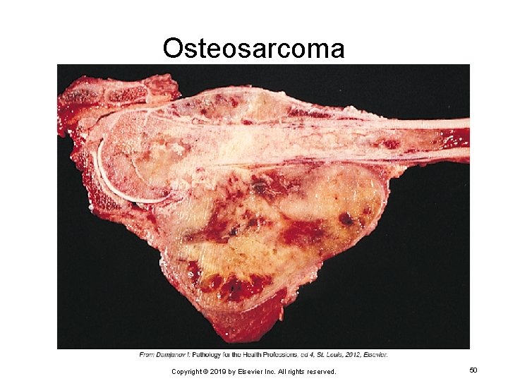 Osteosarcoma Copyright © 2019 by Elsevier Inc. All rights reserved. 50 