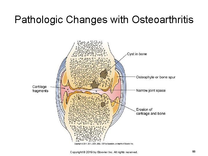 Pathologic Changes with Osteoarthritis Copyright © 2019 by Elsevier Inc. All rights reserved. 66