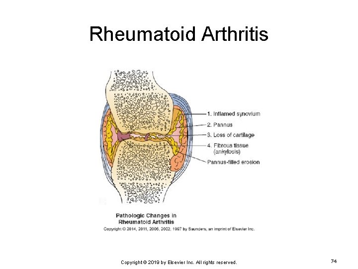 Rheumatoid Arthritis Copyright © 2019 by Elsevier Inc. All rights reserved. 74 