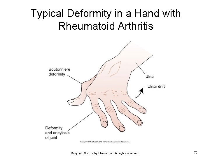 Typical Deformity in a Hand with Rheumatoid Arthritis Copyright © 2019 by Elsevier Inc.
