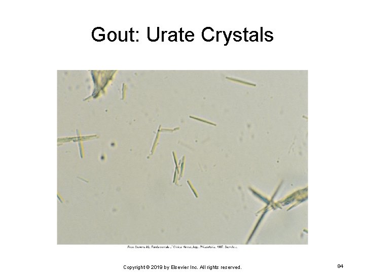 Gout: Urate Crystals Copyright © 2019 by Elsevier Inc. All rights reserved. 84 