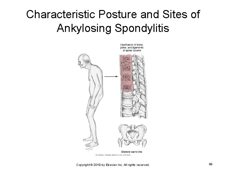 Characteristic Posture and Sites of Ankylosing Spondylitis Copyright © 2019 by Elsevier Inc. All