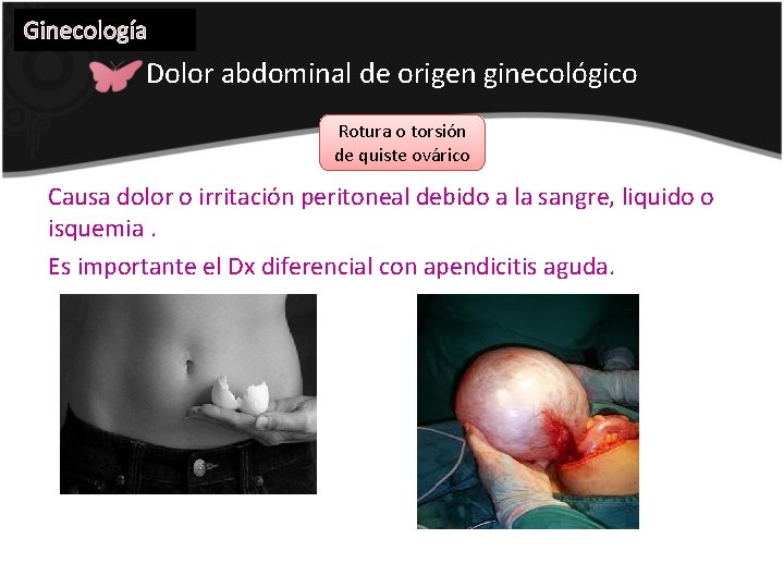 Ginecología Dolor abdominal de origen ginecológico Rotura o torsión de quiste ovárico Causa dolor
