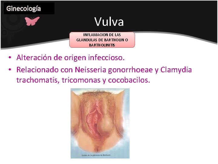 Ginecología Vulva INFLAMACION DE LAS GLANDULAS DE BARTHOLIN O BARTHOLINITIS • Alteración de origen