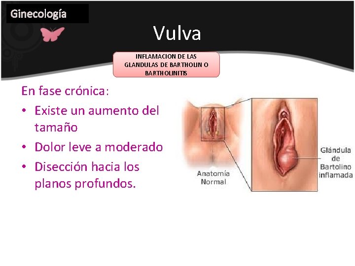 Ginecología Vulva INFLAMACION DE LAS GLANDULAS DE BARTHOLIN O BARTHOLINITIS En fase crónica: •
