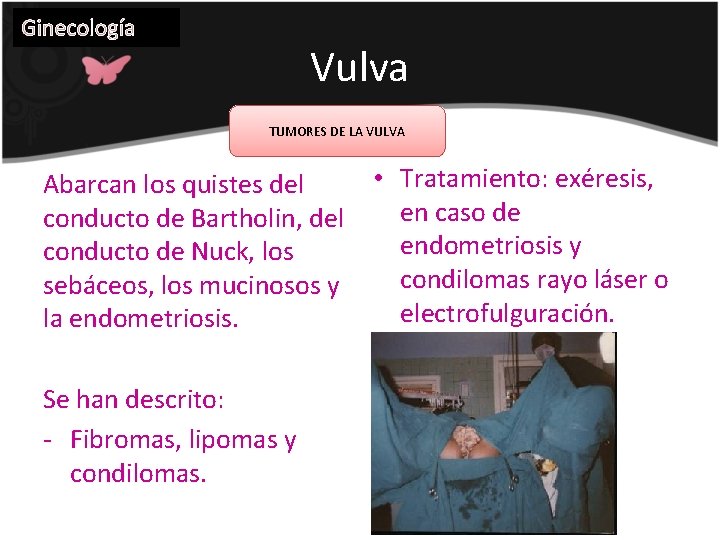 Ginecología Vulva TUMORES DE LA VULVA Abarcan los quistes del conducto de Bartholin, del