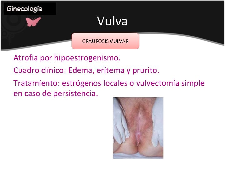 Ginecología Vulva CRAUROSIS VULVAR Atrofia por hipoestrogenismo. Cuadro clínico: Edema, eritema y prurito. Tratamiento: