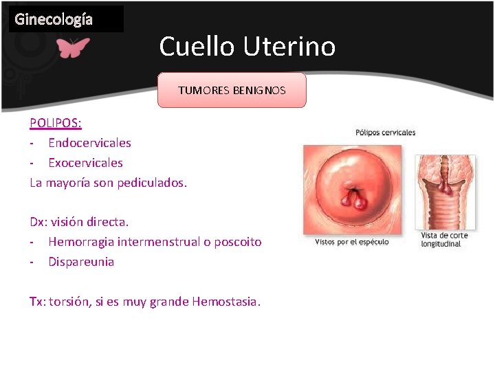 Ginecología Cuello Uterino TUMORES BENIGNOS POLIPOS: - Endocervicales - Exocervicales La mayoría son pediculados.