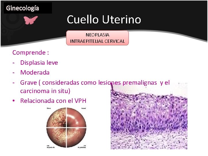 Ginecología Cuello Uterino NEOPLASIA INTRAEPITELIAL CERVICAL Comprende : - Displasia leve - Moderada -