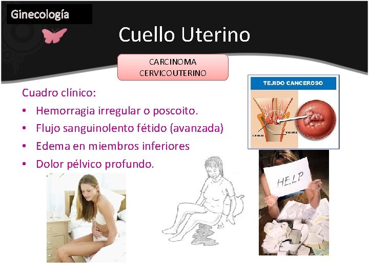 Ginecología Cuello Uterino CARCINOMA CERVICOUTERINO Cuadro clínico: • Hemorragia irregular o poscoito. • Flujo