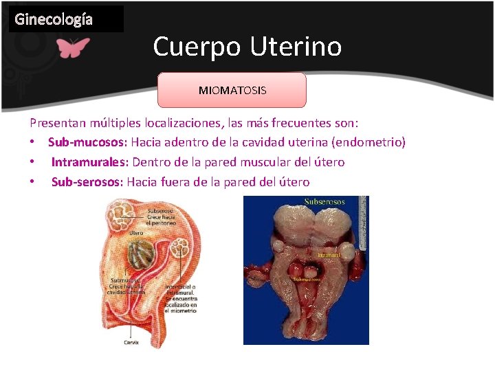 Ginecología Cuerpo Uterino MIOMATOSIS Presentan múltiples localizaciones, las más frecuentes son: • Sub-mucosos: Hacia