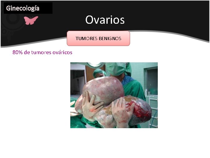 Ginecología Ovarios TUMORES BENIGNOS 80% de tumores ováricos 