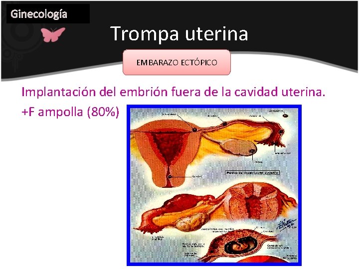 Ginecología Trompa uterina EMBARAZO ECTÓPICO Implantación del embrión fuera de la cavidad uterina. +F